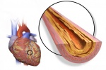 Thiếu máu cơ tim cục bộ nguy hiểm đến mức nào?