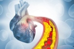 Có những cách nào để điều trị mỡ máu cao phòng ngừa bệnh tim mạch?