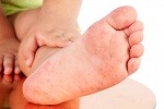 Triệu chứng mới của Covid-19: Cảnh giác với những vết bầm tím ở ngón chân của trẻ