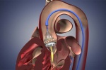 Thay van động mạch chủ qua ống thông bằng gây tê tại chỗ