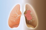 Viêm khớp dạng thấp có thể gây biến chứng phổi?