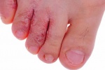 Trị bệnh nấm da chân như thế nào?
