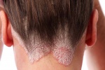 Dấu hiệu của bệnh vảy nến da đầu