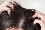 Giải pháp nào cho mái tóc bết dầu?