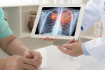 ung thư phổi có phải do di truyền không, phòng ngừa thế nào?
