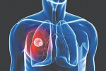 Kéo dài tuổi thọ cho người bị ung thư phổi giai đoạn cuối