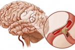 Giúp người bị tai biến mạch máu não nhanh hồi phục bằng cách nào?