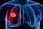 Bệnh u phổi có chữa được không?