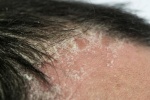 Người bị vảy nến da đầu làm thế nào để điều trị hiệu quả?