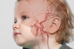 Bé 3 tuổi đột quỵ do túi phình mạch máu não