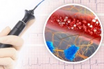 Đốt điện tim trị ngoại tâm thu có rủi ro gì, làm sao ngừa tái phát?