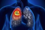 Ung thư phổi: Những dấu hiệu nhận biết sớm không thể bỏ qua