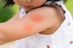 Một vài lưu ý khi chăm trẻ bị sốt xuất huyết tại nhà 
