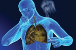 Sử dụng thảo dược để hỗ trợ ngăn ngừa ung thư phổi tái phát