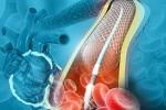 Tắc hẹp mạch vành: Khi nào cần đặt stent mạch vành?