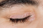 Cách ngăn ngừa biến chứng ở vảy nến vùng mắt