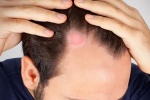 Cách trị nấm da đầu tại nhà hiệu quả