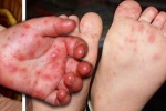 Cảnh giác với bệnh tay chân miệng gây biến chứng nguy hiểm cho trẻ