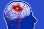 Tại sao người bị xơ vữa động mạch có nguy cơ đột quỵ, tai biến mạch máu não?