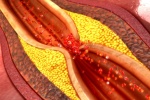 Mỡ máu cao nguy cơ gây xơ vữa động mạch