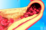 Mỡ máu cao không có triệu chứng làm tăng nguy cơ xơ vữa động mạch, đột quỵ