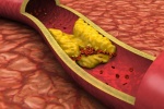 Người mỡ máu cao nên và không nên ăn gì để phòng ngừa xơ vữa động mạch
