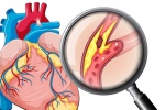 Các biện pháp để xác định bệnh xơ vữa động mạch vành hiện nay