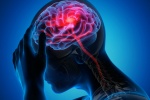  5 biến chứng thường gặp của nhồi máu não