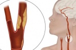 Xơ vữa động mạch cảnh: Nguyên nhân và dấu hiệu nhận biết thế nào?