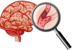 Chẩn đoán xơ vữa động mạch não như thế nào?