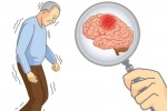 5 dấu hiệu cảnh báo cơn nhồi máu não sắp ập đến