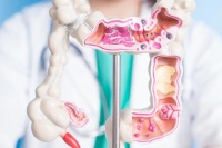 4 yếu tố làm tăng nguy cơ ung thư đại trực tràng