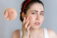 Biện pháp xử lý mụn trứng cá tại nhà