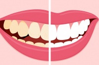 Các loại thực phẩm, đồ uống nào dễ khiến răng ố vàng?