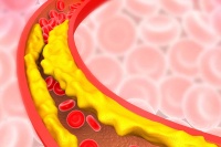 Dấu hiệu tắc nghẽn động mạch chớ chủ quan