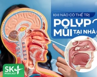 Podcast: Khi nào có thể trị polyp mũi tại nhà?