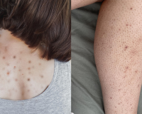 Giải pháp giúp làn da cơ thể mịn màng, hết mụn