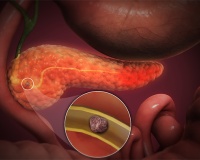 Có sỏi ống tụy 12mm cần xử trí thế nào để kiểm soát bệnh?