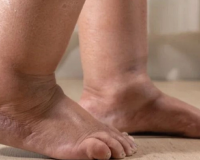 Sưng tấy bàn chân kéo dài cảnh báo dấu hiệu bệnh lý gì?