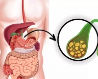 Sỏi túi mật 7,5mm có nguy hiểm không?