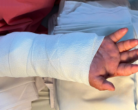 Nối lại bàn tay đứt lìa cho sản phụ, sau 2 tháng được 'ghép tạm' vào chân