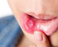 Dấu hiệu ở miệng chứng tỏ bạn thiếu vitamin B12