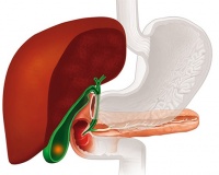 Sỏi mật 25mm dùng TPBVSK Kim Đởm Khang được không?