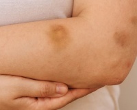 Hay bầm tím, cẩn thận thiếu vi chất