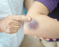 Dễ bị bầm tím, vì bạn đang thiếu loại vitamin này 