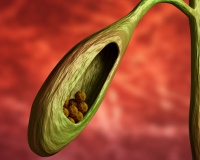 Sỏi túi mật 4,5mm dùng TPBVSK Kim Đởm Khang được không?