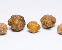 Sỏi mật 39mm nguy hiểm tới thế nào?