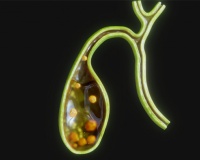 Có sỏi túi mật 21mm dùng TPBVSK Kim Đởm Khang được không?