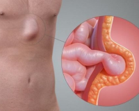 Làm thế nào để tự đánh giá nguy cơ mắc thoát vị?