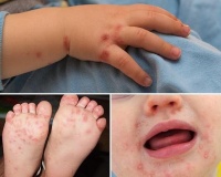 Sốt xuất huyết và tay chân miệng cùng gia tăng mạnh